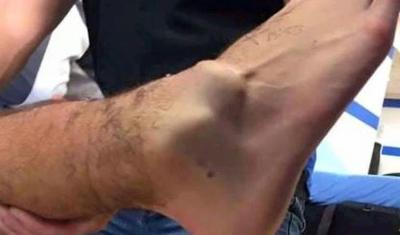 Ayağı sınan futbolçunun aqibəti necə olacaq? -