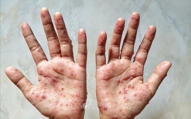 Bu virus yenidən yayılır: Fövqəladə vəziyyət elan olunacaq..