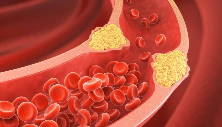 Xolesterini azaldan meyvə - Ürək-damar xəstəliklərinin qarşısını alır