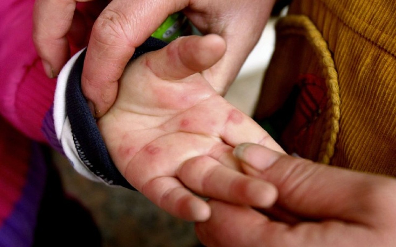 Əgər ayaq və əllərinizdə göbələk varsa, mütləq bunu edin!