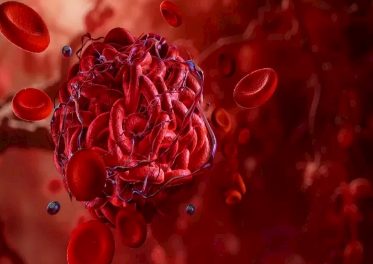 Tromb ola biləcəyini göstərən əsas narahatedici əlamətləri tanıyın!